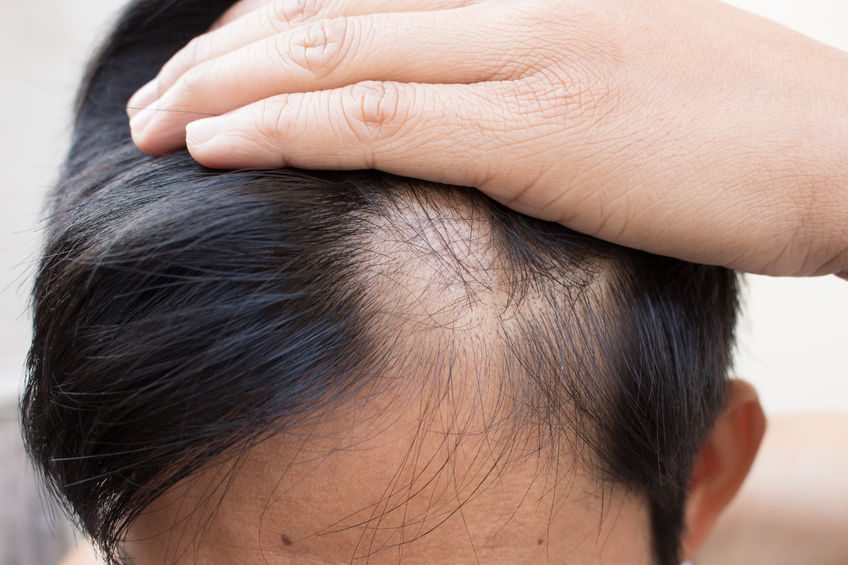 Veradermics (MANE) Positioned to Disrupt Hair Loss Market